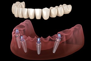 a digital illustration depicting All-on-4 dental implants